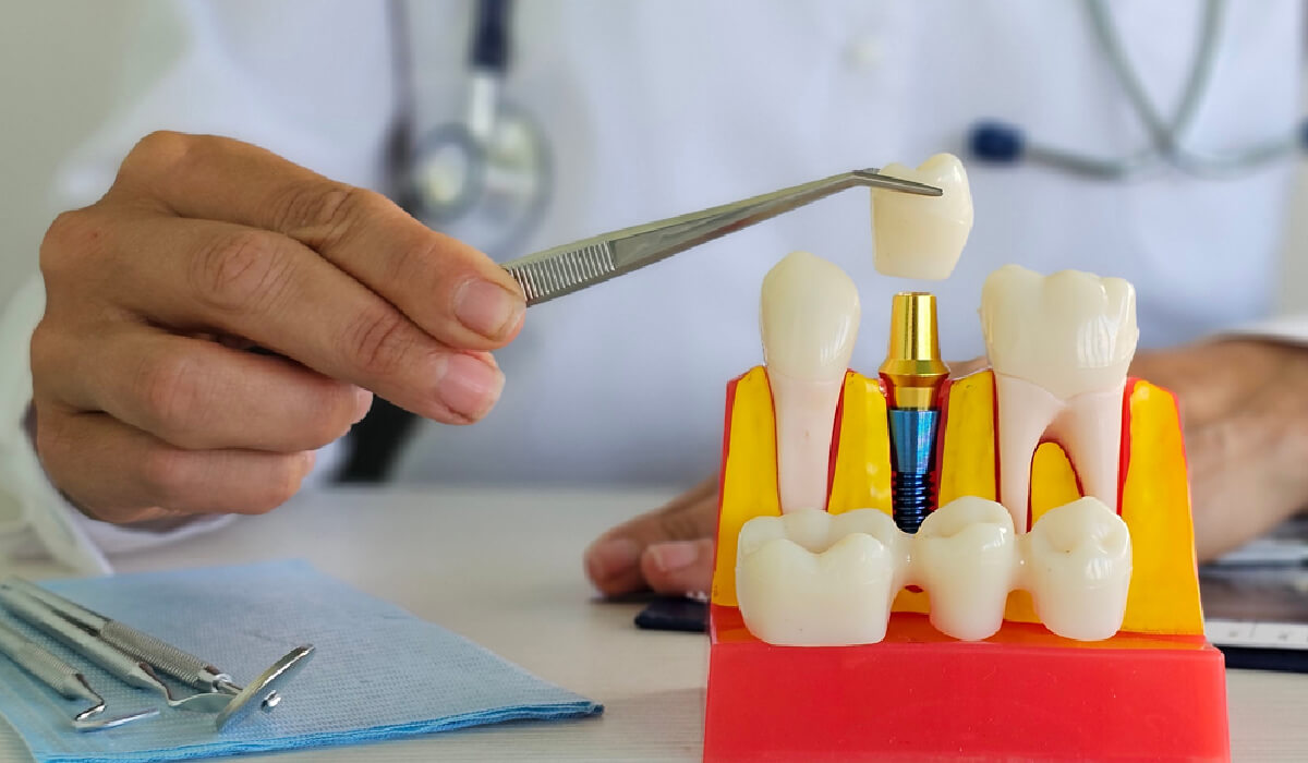 Implantologists (Dental Implants)