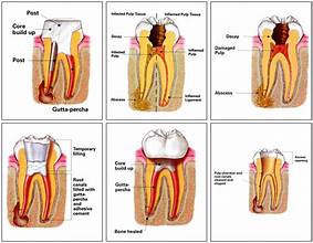 Endodontists (Root Canal)